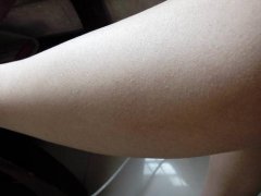 国仁仙姿：瘦腿针后遗症有哪些？